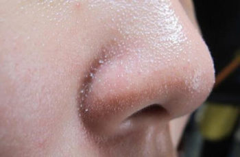 Soi ba nhon la gi Cach dieu tri soi ba nhon hieu qua tai nha 3