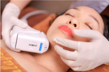 Cong nghe ultherapy co tot khong